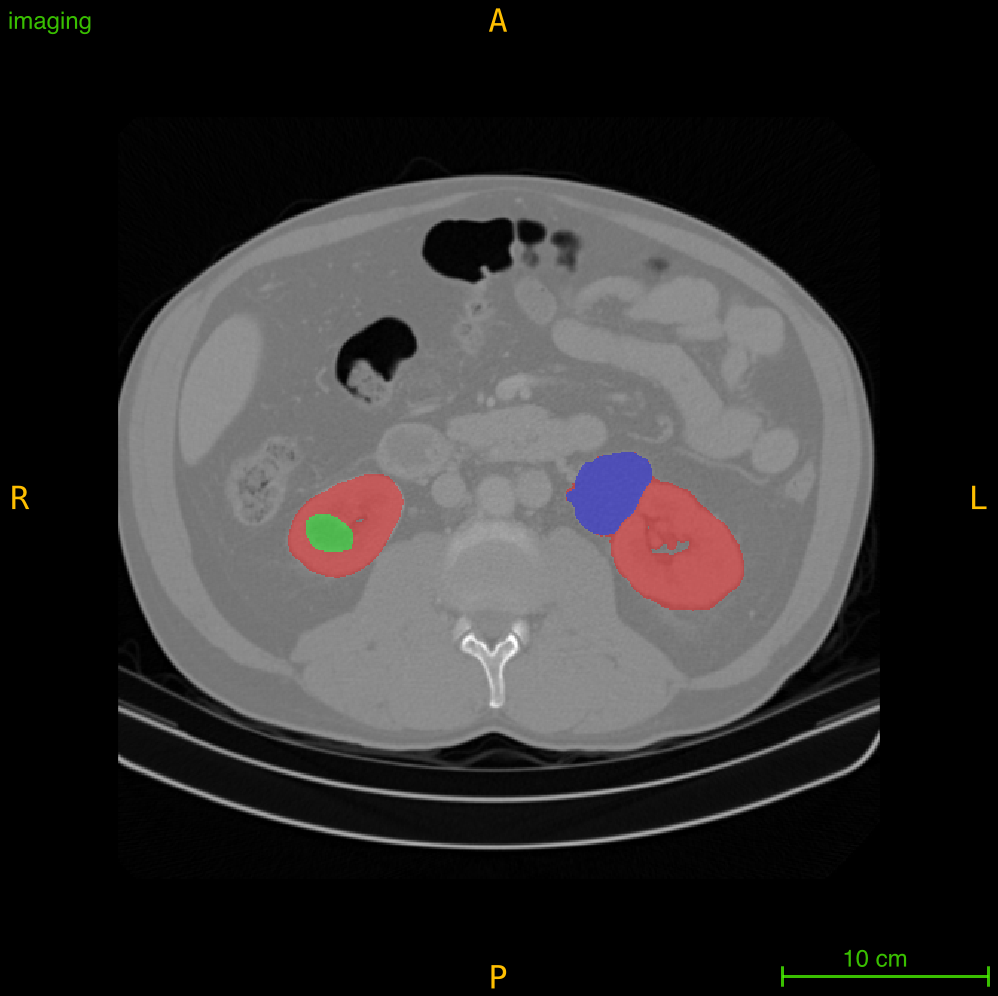 AI-Driven Classification of Tumor Operability using 3D-CT Scans